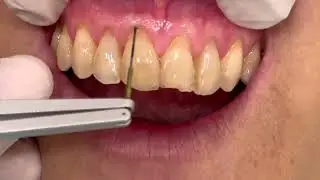 Florida Probe System