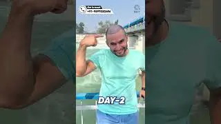 Amazing Hair Transplant Results | Latest Fue Technique #shorts #viral #hair transplant