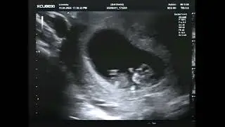 2D Echo 10 Weken  Filmpje