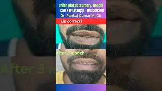 perfection in lip reduction surgery| Lip reduction surgery in Ranchi| Best lip reduction surgery