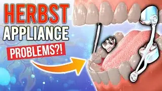 Herbst Appliance Problems With BRACES?!