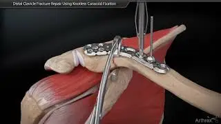 Fracture de la clavicule - Chirurgie ost&eacute;osynth&egrave;se par plaque - Dr Simon Tournemine