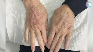 Radiesse to back of hands