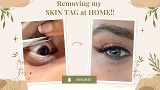 Removing my SKIN TAG from my eyelash at HOME!!