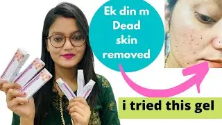 Clinsol gel review || specially acne oily skin