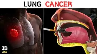 Lung Cancer | Animated Video | Learn Biology With Musawir