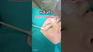 หลังทำ หัตถการSubbrow Lift #หมอเฟิร์นfernclinic #subbrowlift #ตาสวย #ศัลยกรรม #เทรนด์วันนี้