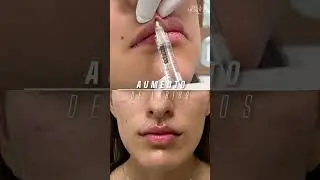 Aumento de labios con &aacute;cido hialur&oacute;nico 💋✨