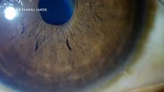 CLINICAL PEARL - THICK CORNEAL NERVES - DR PANKAJ LANDE 21 MAY 2025