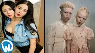 10 Most Unique Twins In The World