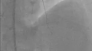 PCI to CTO LAD using microcatheter assisted antegrade wire escalation (case 1) (Delta cath.Lab)