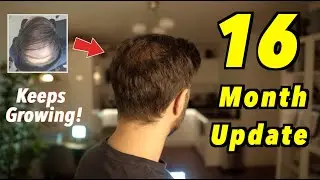 16 Month 2nd Hair Transplant Update | 4000 GRAFTS FUE | STILL GROWING