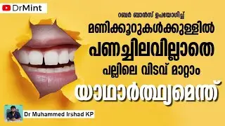 | പല്ലിലെ വിടവ്  മാറ്റാം,പൈസ ചെലവില്ലാതെ 10 ദിവസം കൊണ്ട്  | യാഥാർത്യം | Closing tooth gap |