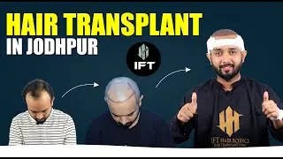 Hair Transplant In Jodhpur: Watch This First | IFT Hair Science