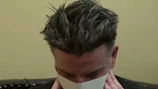 Successful Male Hair Loss Treatment by San Francisco Hair Transplant