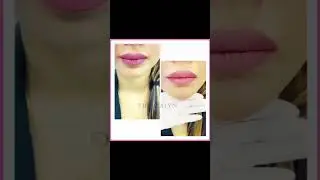 Chin Reshaping with Dermal Fillers | Dermalyn Aesthetics | Permanent Makeup Clinic | Dr.Muskan Tyagi