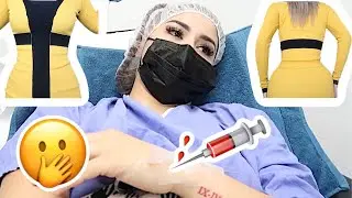 1 WEEK POST OP (BBL & LIPO) (BEFORE|AFTER)