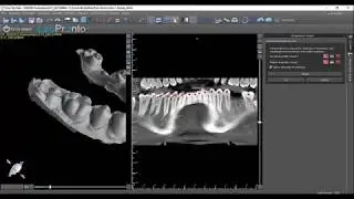 Videocorso del software 3D per chirurgia guidata BlueSkyPlan: trailer