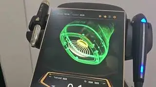 360 MAX HIFU: Liposonix  Onsite Treatment Showing