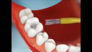 No more Black Spot Plaques   Removing Cavity on Teeth Procedure