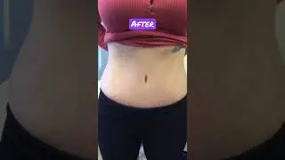 Tummy Tuck Before and After on Mom of Triplets! #tummytuckbeforeandafter