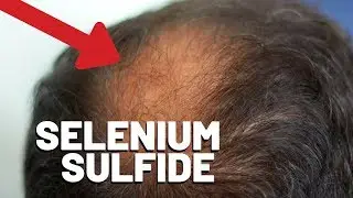 Selenium Sulfide and Hair Loss - Is There a Connection?