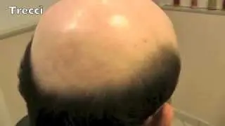 0823.1841236 protesi capelli Napoli, Caserta per diradamento calvizie