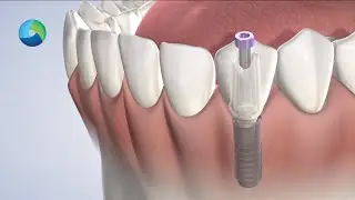 Dental Implant Quality in New Brunswick NJ: Dr. Richard Stern | Oral Surgery Group