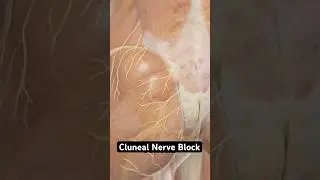 Cluneal Nerve Block (3D Animation)