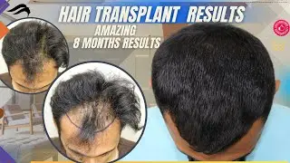 Hair Transplant In Mangalore | Best Cost Surgeon & Clinic Of Hair Transplant In Mangalore