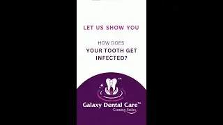 How Does Your Tooth Infected? Why Root Canal Treatment is Required? Galaxy Dental Care | Kondapur