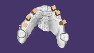 The Future of Dental Implants: Precision Measurement with iCam4D by Imetric