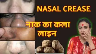 नाक के काले घेरे ऐसे ठीक करे | nose black mark remove home remedy