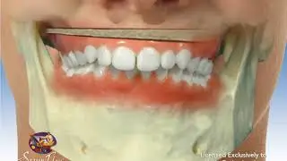 Maxillary Lift