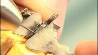 Primotec phaser welder welding bridge interproximally with shim