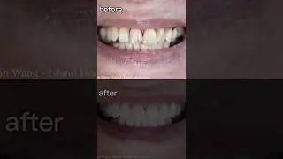 INCREDIBLE BEFORE AND AFTER SMILE TRANSFORMATION #affordablesmiles #dentist #smiledentist