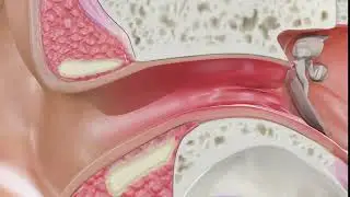 Otitis Externa