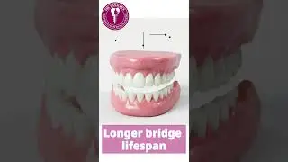 Best Dental Clinic in Hadapsar | Smart Dental Bridge with Non-Rigid Connector