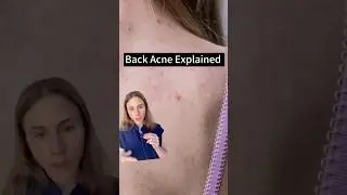 Uncovering The Truth About Back Acne