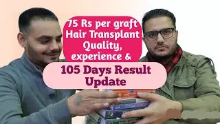 Shadab Hair Transplant Surgery Experience After 105 Days - Eugenix Clinic - 1200 Grafts