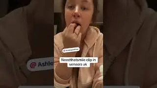 Needthatsmile clip in veneers uk missing teeth clip on veneers new smile