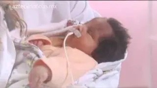 Piden apoyo para beb&eacute; con malformaciones