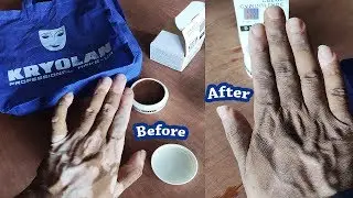 Best Makeup for Vitiligo | Waterproof Camouflage Cream