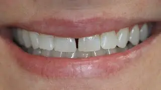 Houston Cosmetic Dentist...Dislike your Gap between your front teeth? 1 Hour Cosmetic Bonding:)