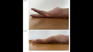 Sujok Therapy for Dupuytren&rsquo;s Contracture | Real Client Results & Non-Surgical Approach