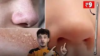 OMG! This Tool Remove Blackheads & Whiteheads Like Magic! 😱