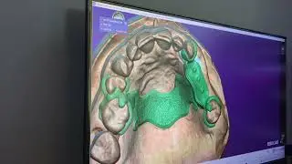 Partial Framework Design - Dise&ntilde;o de Pr&oacute;tesis Parcial Removible. Exocad/PartialCad PARTE 1