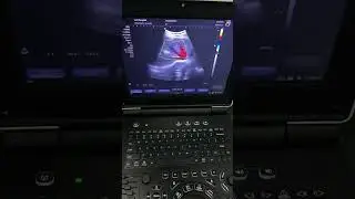 Good Color Doppler