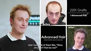 Maxim's Amazing Advanced FUE Transformation | Advanced Hair Experience