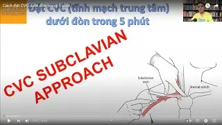 Cách đặt CVC dưới đòn trong 5 phút